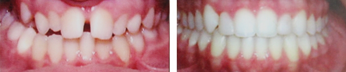 后牙反颌案例