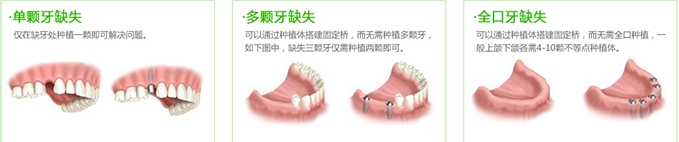 牙齿种植案例